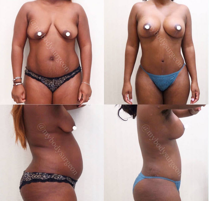 Breast Lift with Breast Implants